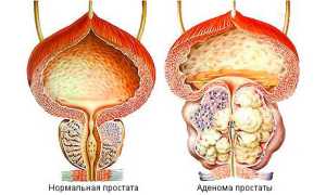 Основные симптомы аденомы простаты