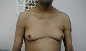 Признаки с фото и лечение гинекомастии у мужчин