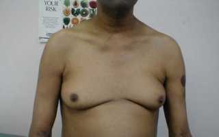 Признаки с фото и лечение гинекомастии у мужчин