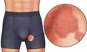 Зуд половых органов и в промежности у мужчин