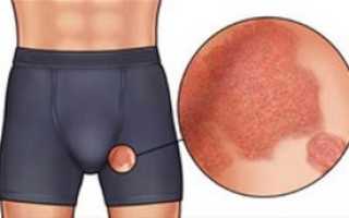 Зуд половых органов и в промежности у мужчин