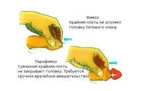 Что такое сужение крайней плоти у взрослых: лечение и симптомы