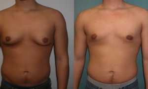 Симптомы и причины развития гинекомастии у мужчин