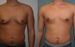 Симптомы и причины развития гинекомастии у мужчин