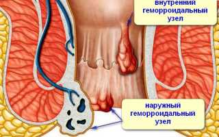Как правильно лечить геморрой у мужчин