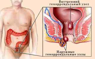 Влияет ли геморрой на потенцию и каким образом?