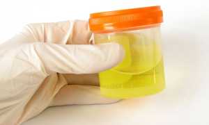 О чем может говорить повышенный белок в моче у мужчин?