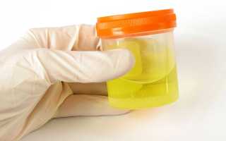 О чем может говорить повышенный белок в моче у мужчин?