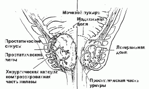 Каковы допустимые размеры аденомы простаты?