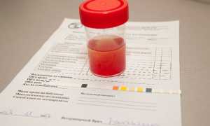 Чем опасна моча красного цвета у мужчин?