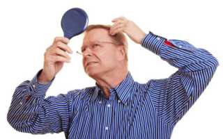 Облысение у мужчин в разном возрасте: как остановить