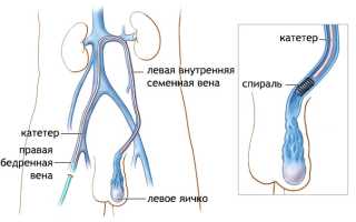Урология: двустороннее варикоцеле как частое заболевание