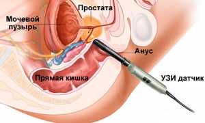 Метод ТРУЗИ простаты и правильная подготовка к нему