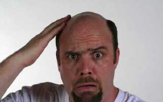 Почему у мужчин выпадают волосы