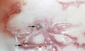Что такое крауроз полового члена и как он проявляется?