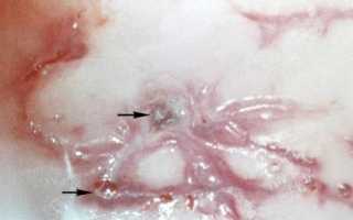 Что такое крауроз полового члена и как он проявляется?