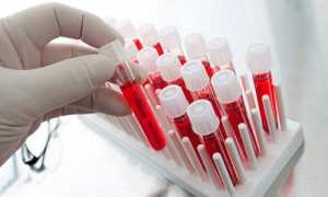 Как можно определить РОЭ в крови: норма у мужчин