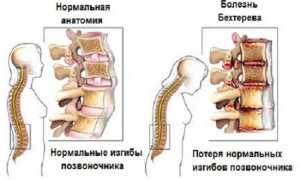 Болезнь Бехтерева у мужчин: проявления и лечение
