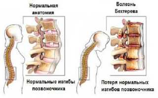 Болезнь Бехтерева у мужчин: проявления и лечение