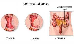 Какими могут быть симптомы рака прямой кишки у мужчин