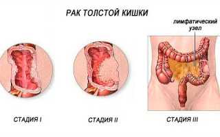 Какими могут быть симптомы рака прямой кишки у мужчин