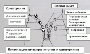 Как возникает правосторонний крипторхизм?