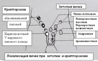 Как возникает правосторонний крипторхизм?