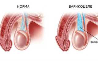 Лечение варикоцеле в домашних условиях: методы и рецепты