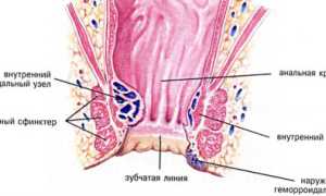 Как правильно лечить геморрой у мужчин в домашних условиях?