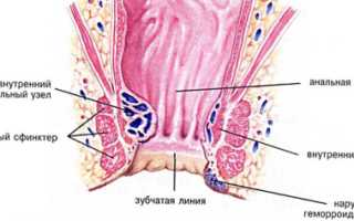 Как правильно лечить геморрой у мужчин в домашних условиях?