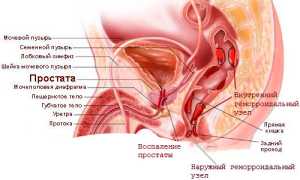 Воспаление простаты и его симптомы
