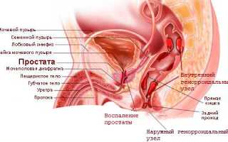 Воспаление простаты и его симптомы