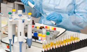 Подробная расшифровка результатов анализа секрета простаты