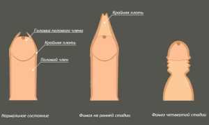 Симптомы и методы лечения относительного фимоза
