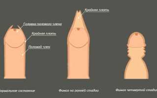 Симптомы и методы лечения относительного фимоза
