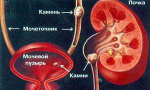 Оперативное удаление камней из мочевого пузыря у мужчин