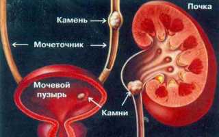 Оперативное удаление камней из мочевого пузыря у мужчин
