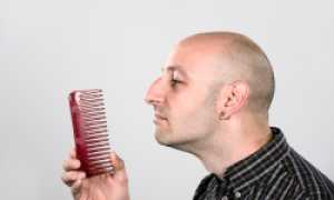 Сильно выпадают волосы у мужчины — что делать?