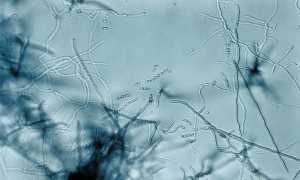 Почему появляются красные пятна на головке и крайней плоти?