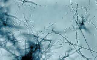 Почему появляются красные пятна на головке и крайней плоти?