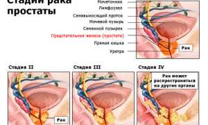 Правильная диета при раке предстательной железы