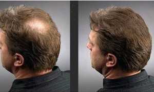 Как проводят наращивание волос для мужчин?