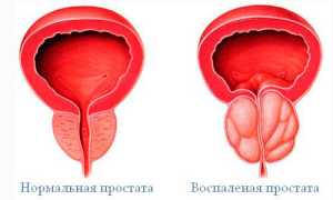 Последние достижения в диагностике и лечении рака простаты
