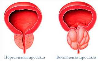Последние достижения в диагностике и лечении рака простаты