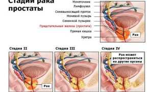 Лечится ли рак простаты 4 степени?