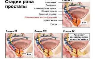 Лечится ли рак простаты 4 степени?