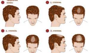 Почему возникают залысины у мужчин?
