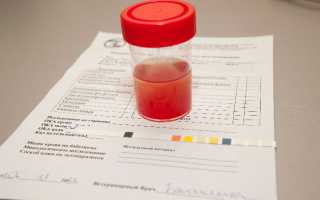 Что означает кровь в моче у мужчин?