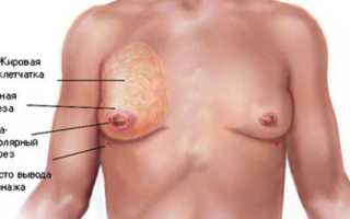 Почему у мужчины увеличены молочные железы?