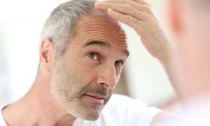 Почему у мужчин часто выпадают волосы на голове?